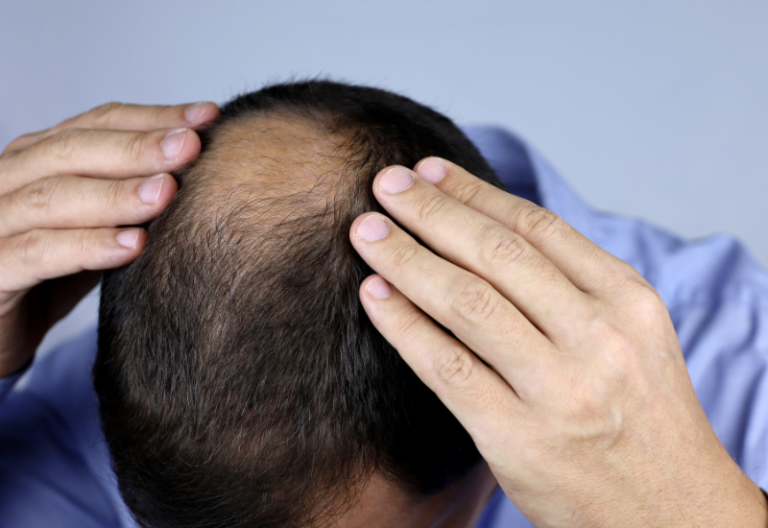 Hair Loss Treatment