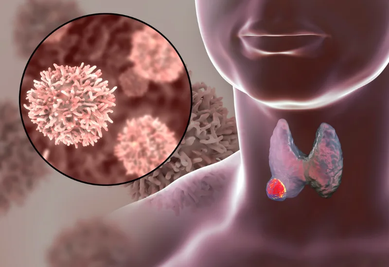 Endocrine Disease Treatment in Dubai